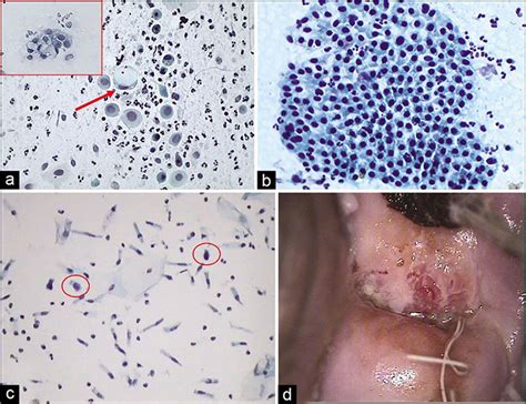 mild inflammation on pap smear